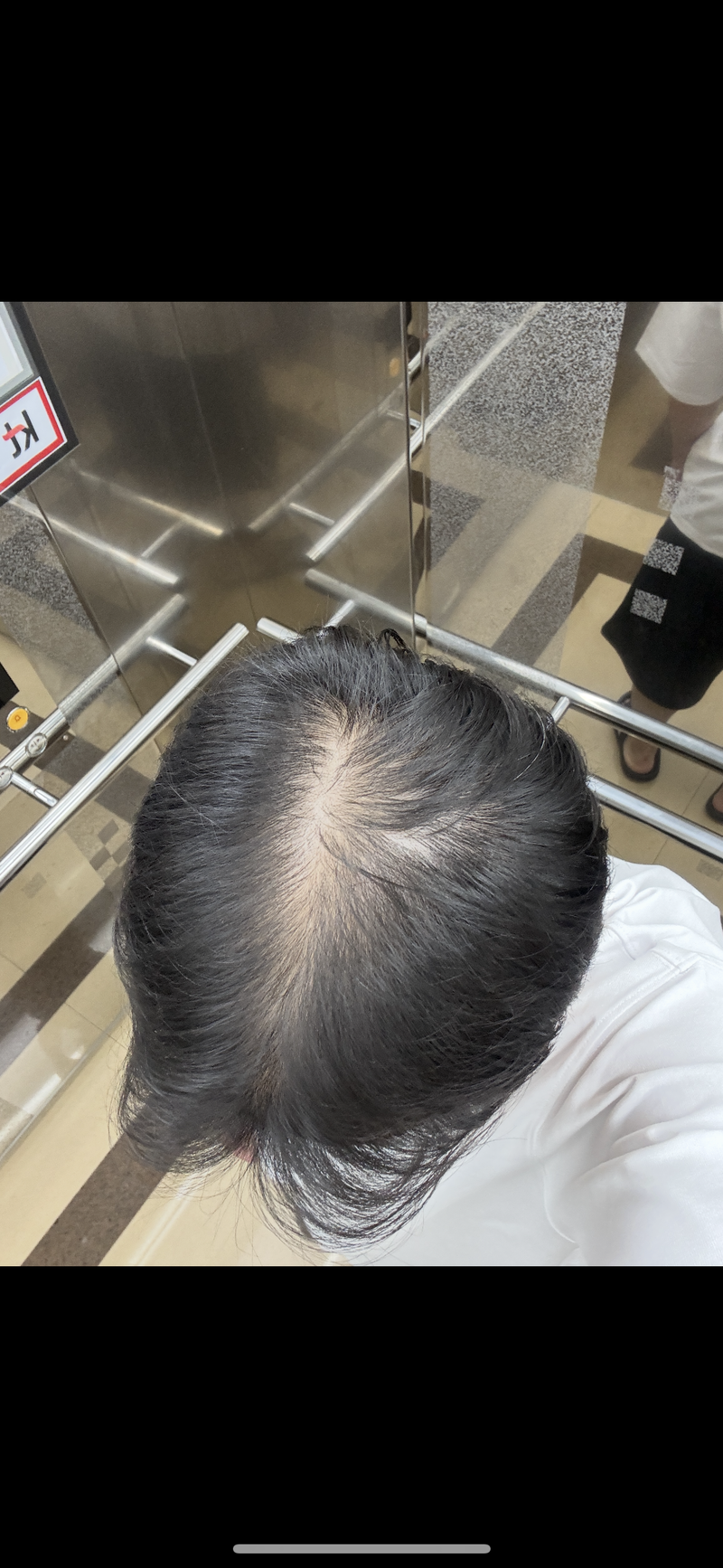 頭頂フィナステリド