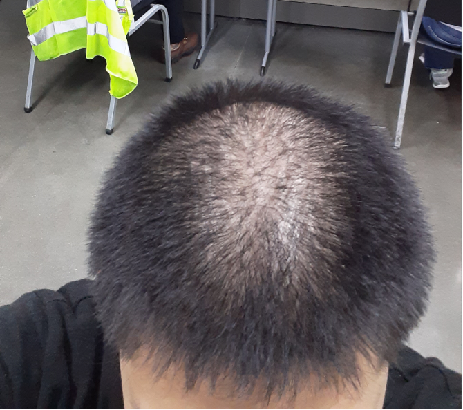 27살 탈모 입니다. 프로페시아 2달 복용 전 후 사진 올립니다.