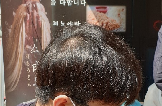 23세 남)이정도면 어느정도 심각한 탈모인가요? 옆에서 볼때랑 위에서 볼때랑 느낌이 너무 다릅니다