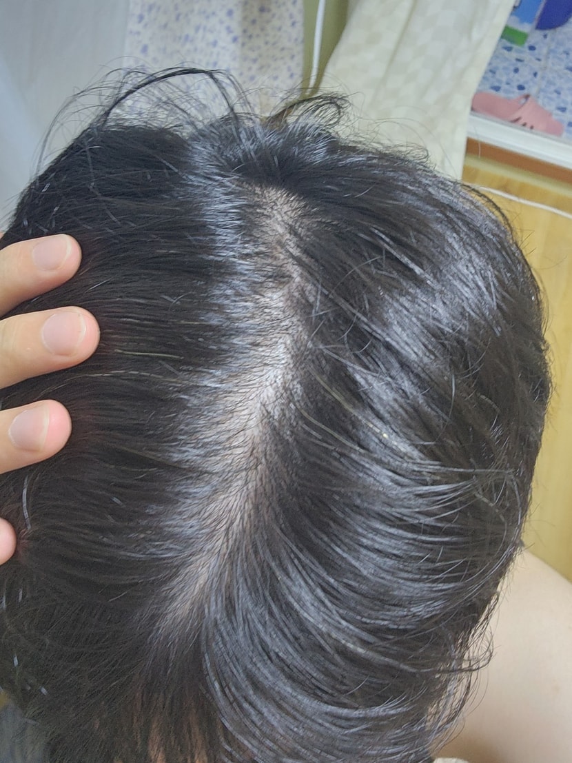 피나 4개월 복용후 찍은사진