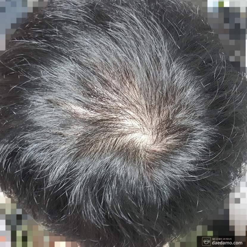 복용 113일차