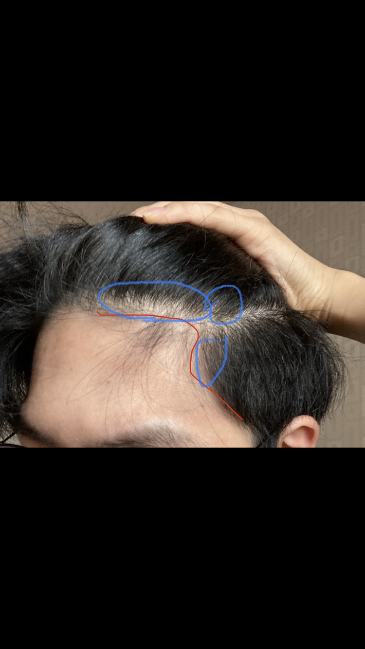 10월: m자 뿐만 아니라 파란 동그라미부분의 전체적인 이마 라인이 연모화돰