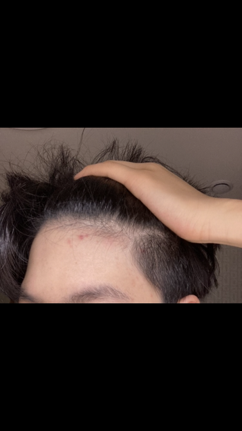 5월 2일 : 탈모를 의심한후 처음으로 찍은 최초의 이마사진