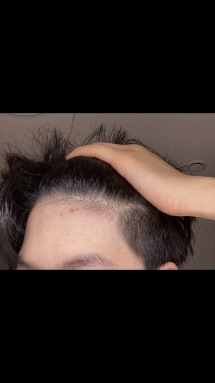 5월 2일 : 탈모를 의심한후 처음으로 찍은 최초의 이마사진 