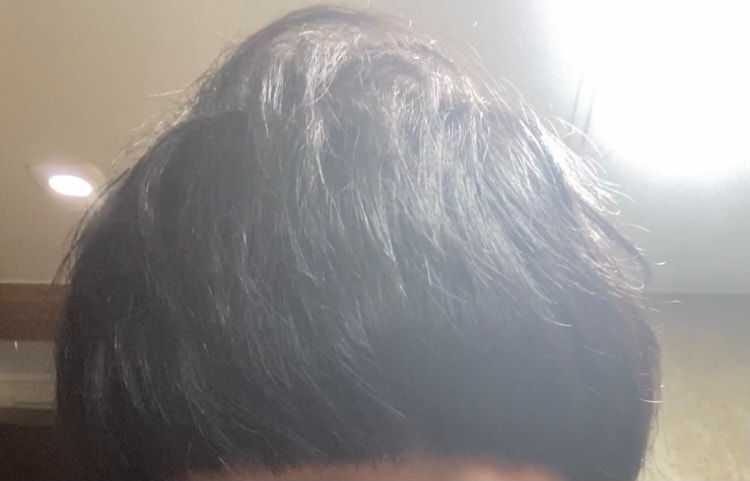 탈모오기전 머리카락