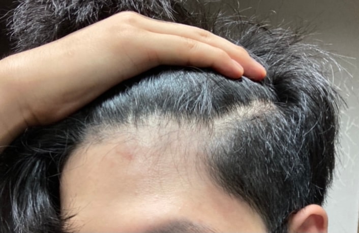 8월: 기존 헤어라인 작살