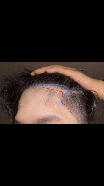 9월: 탈모병원 간 날