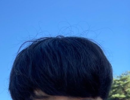 탈모온후 머리카락: 정수리 부분이 완전히 가라앉아서 머리가 납작해짐