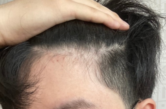 7월: 슬슬 헤어라인이 지저분해진다는 걸 확인가능