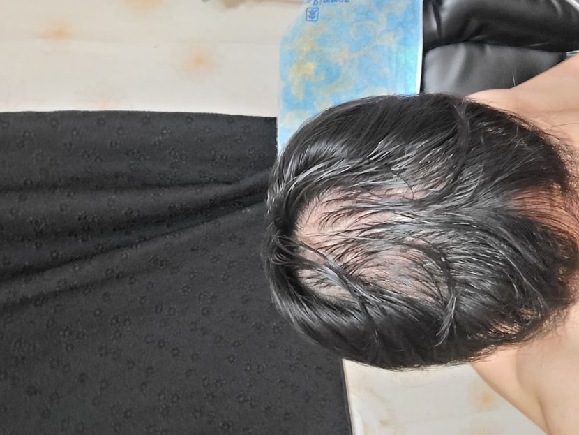 미녹시딜 처음 발랐을때 모습 입니다. 3월 13일