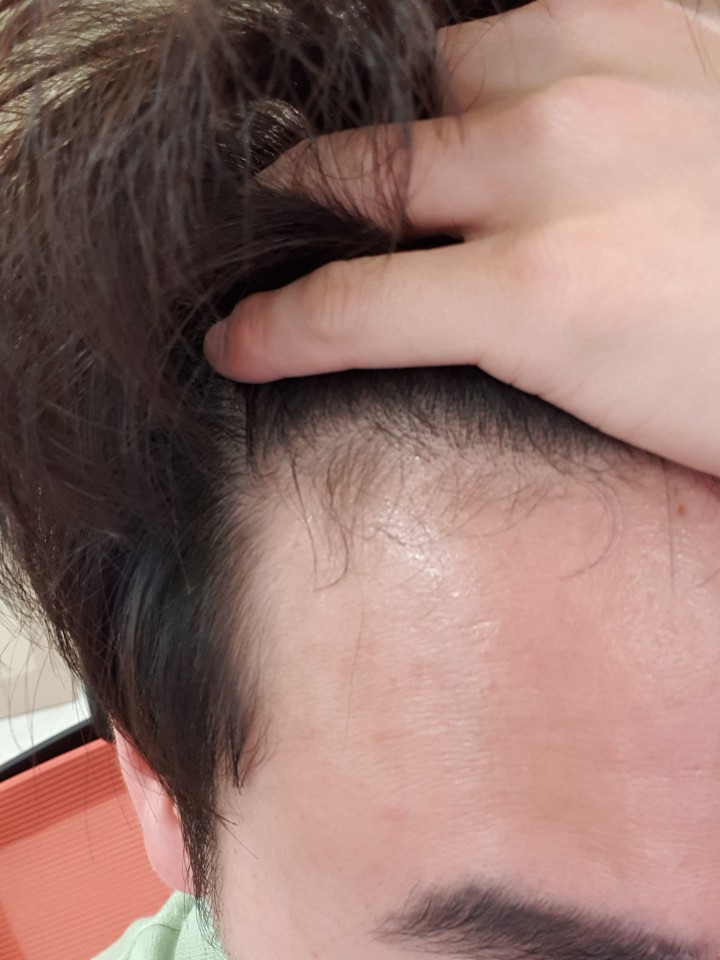 점점 M자 머리로 바뀌고 있어요~~ㅠㅠ