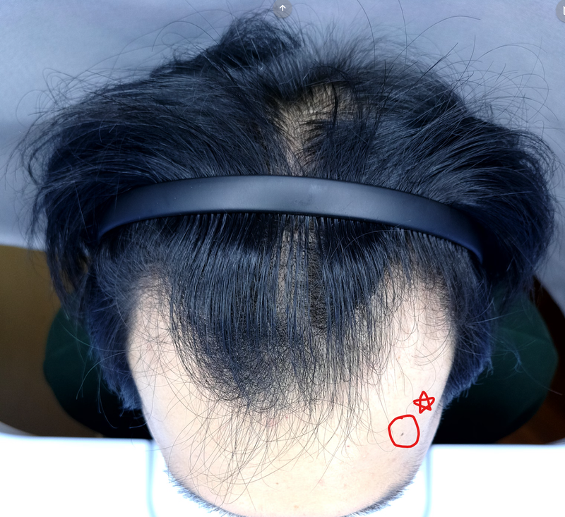 이수민치료전1.png