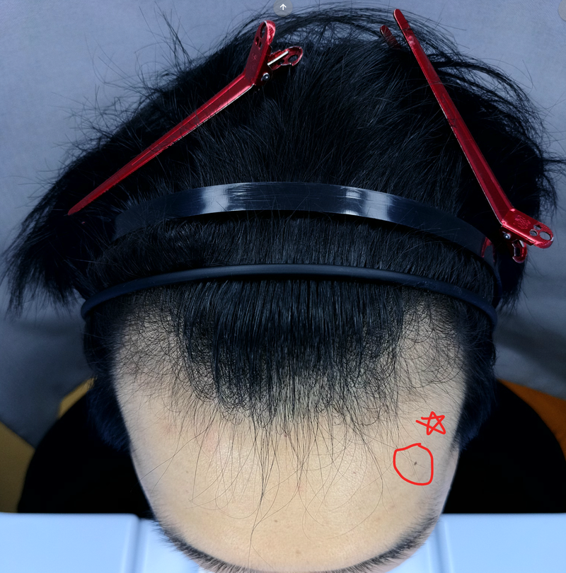 이수민92 치료후5.png