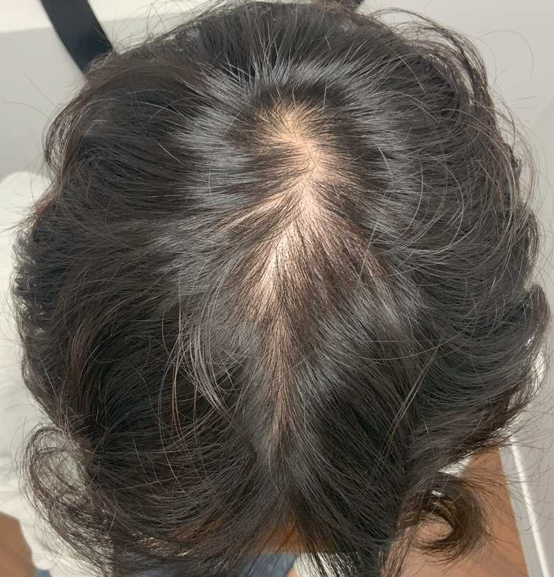 종로 ㅇㅅㅁㅂㄹ 주사치료 병행 8개월차 후기+약도 꾸준히 먹는중