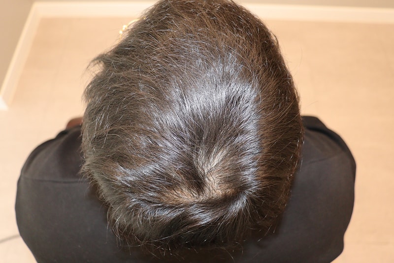 7회경과_정수리 1.jpeg