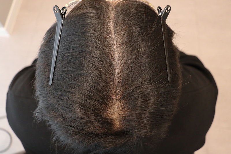 7회경과_정수리 2.jpeg