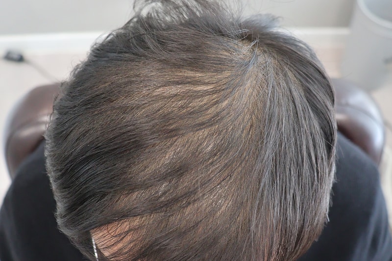 동탄 헤어로의원_염승헌님 두피치료후2.jpg