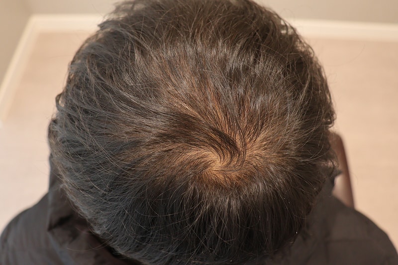 시술 전_정수리.jpeg