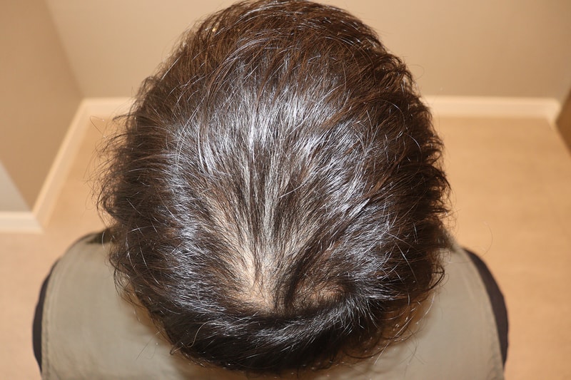 시술 전_정수리 1.jpeg