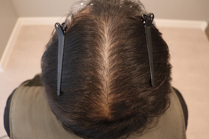 시술 전_정수리 2.jpeg