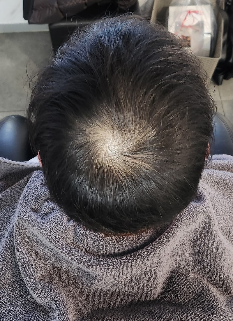 Top of the head, third review of hair loss treatment