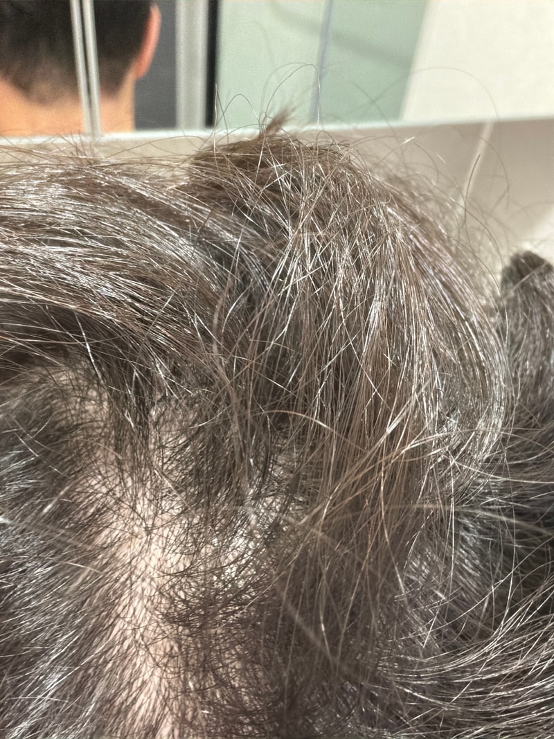 Dongtan hㅇㄹ엑소 It's a mid-term review of exosome hair loss treatment
