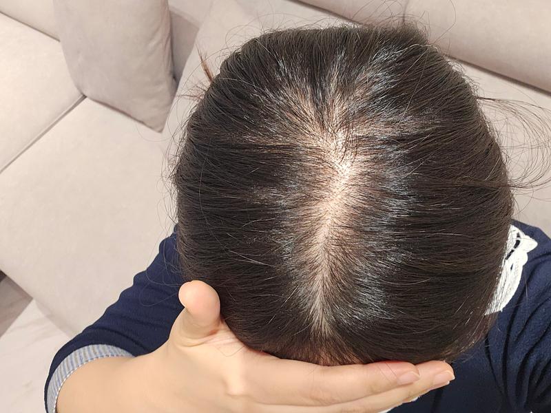 江南駅の女性薄毛治療メゾセラピーを2回目受けてきました。 変化が見えます！