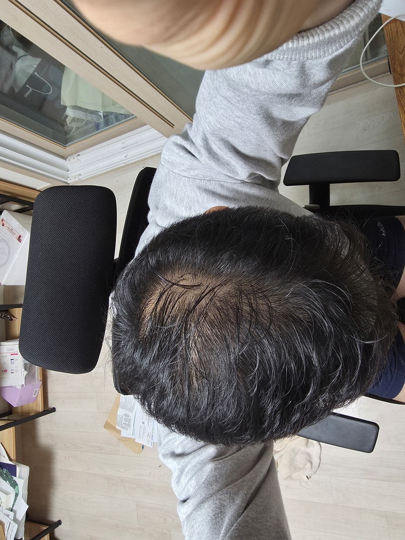 탈모사진.jpg