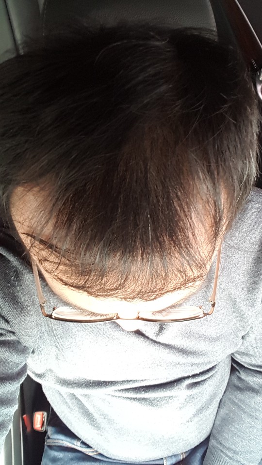 정수리1