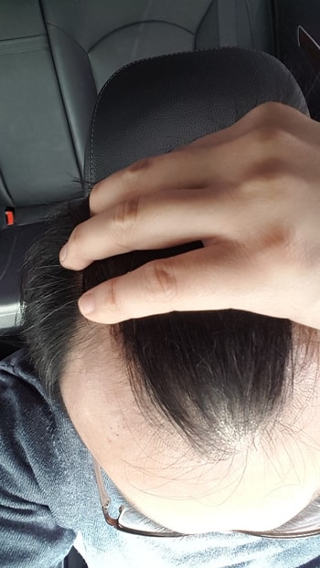 정수리2