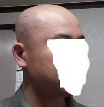 3. 가발 벗고 찍은 모습이예요. 전체가발이라 빡빡 밀었습니다^^;;