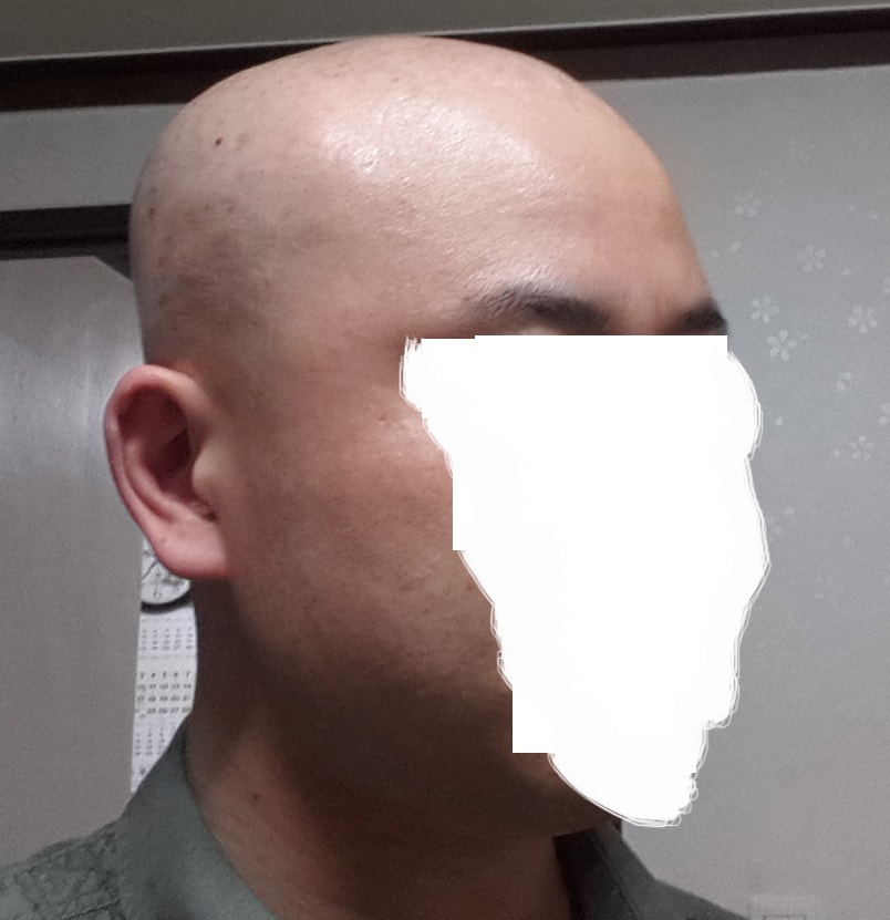 3. 가발 벗고 찍은 모습이예요. 전체가발이라 빡빡 밀었습니다^^;;