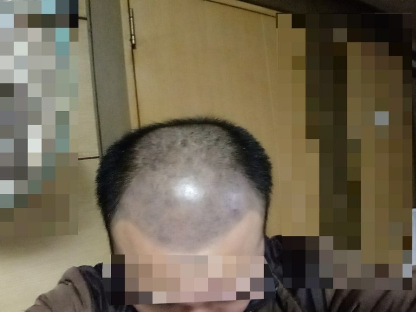 탈모상태1