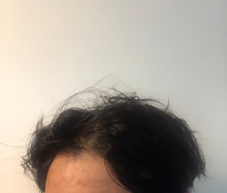 부착하고 자고 일어난 상태입니다 ㅎㅎ 