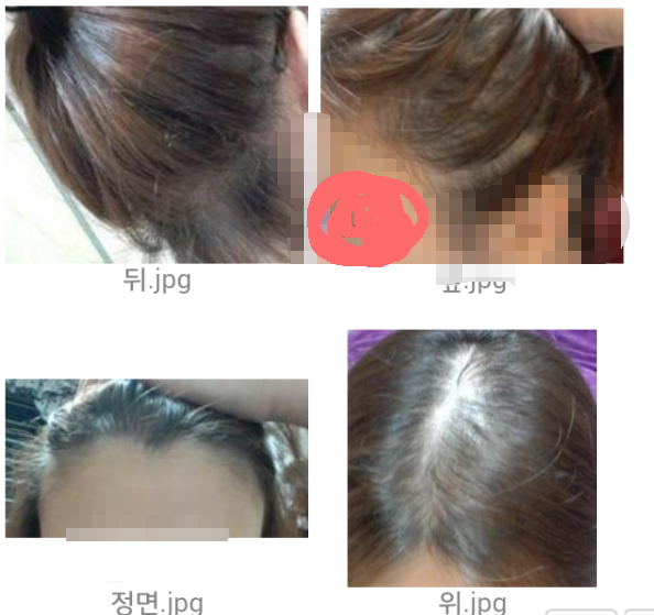 탈모상태