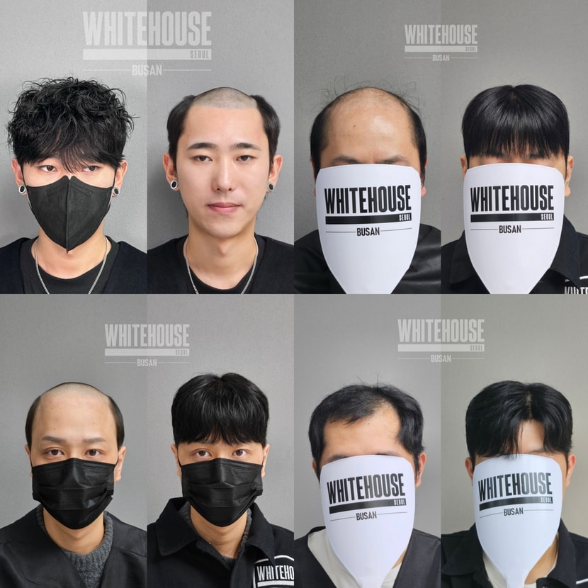남자 정수리 가발