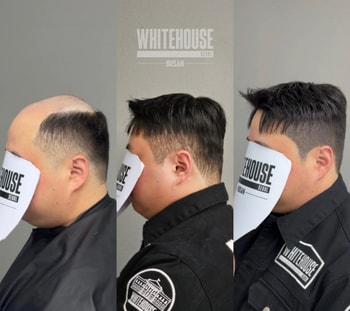 남자 두피커버 정수리 가발