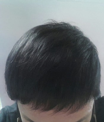 이식후