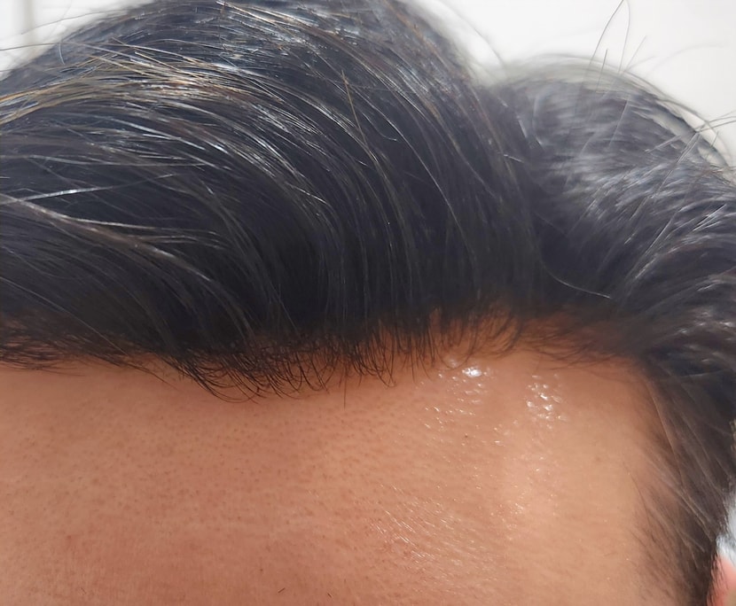 플러스모발 남성맞춤가발  30대 이마라인 