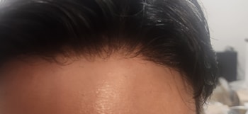 플러스모발 남성맞춤가발  40대 시술후기 이마라인 접사