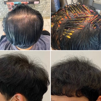 링거펌으로 볼륨,갈라짐교정.