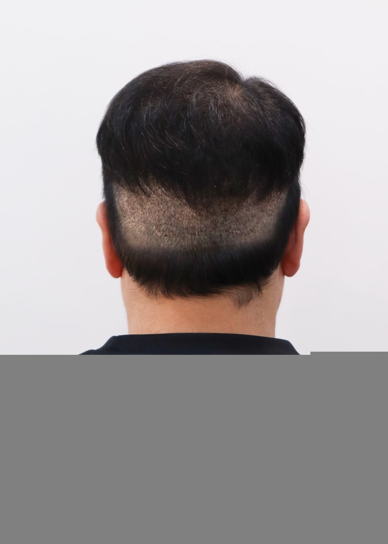 모발이식 채취 삭발부위 커버