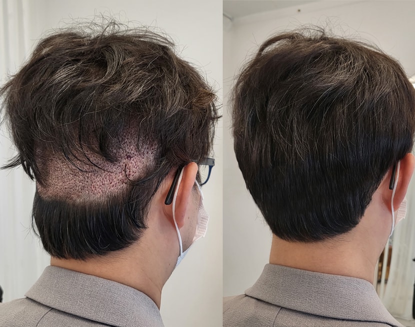 모발이식 뒷머리커버1