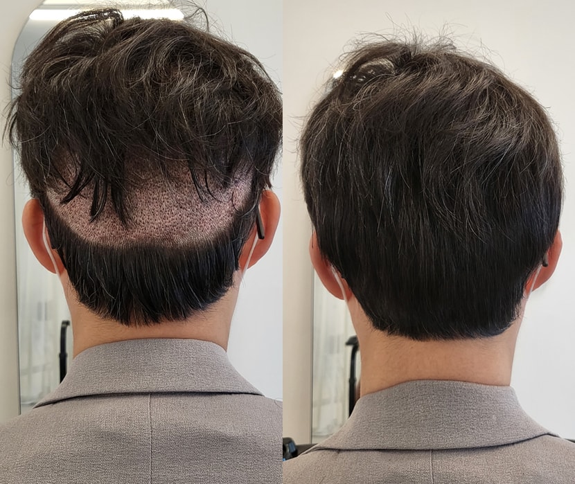 모발이식 뒷머리 커버