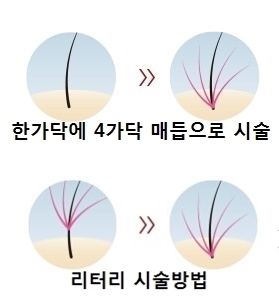 모발이식후4.jpg