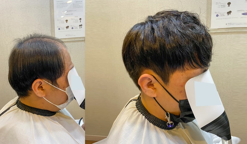 디자인볼륨펌 옆모습 비포&에프터