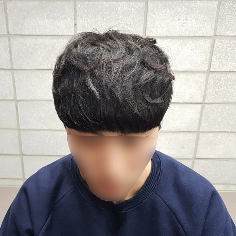 탈모치료7.jpg