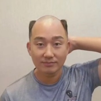 아이비리그컷 남자가발 비포