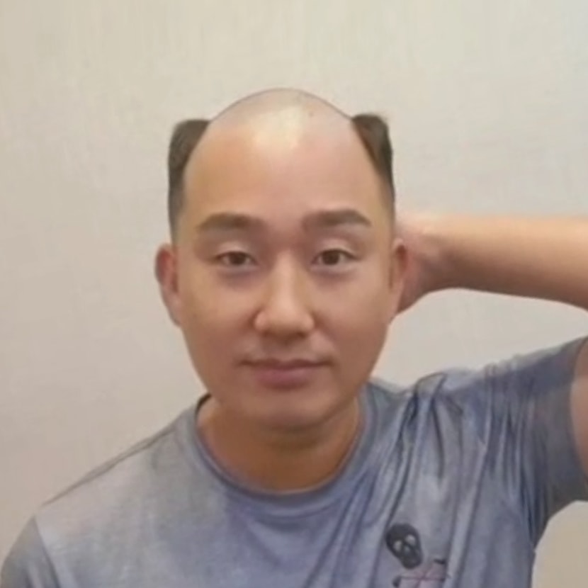 아이비리그컷 남자가발 비포