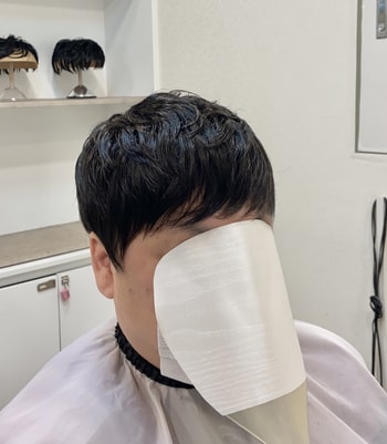 탑, 정수리 탈모 AFTER